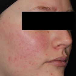 AviClear Before & After Patient #1672